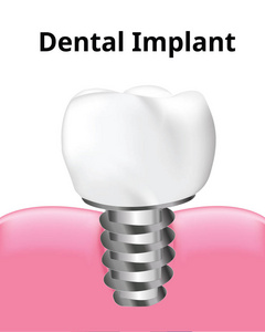 牙种植体与牙龈螺钉分离在白色背景真实插图载体上。