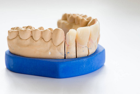 牙科石膏模型在牙科实验室办公室关闭。 石膏假牙与瓷牙隔离在白色背景复制空间