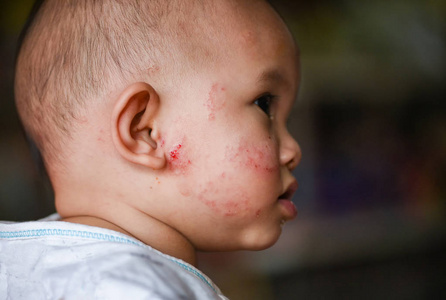 亚洲新生儿皮肤过敏引起的皮疹宝宝对面部疾病宝宝面部干燥皮肤瘙痒及病变
