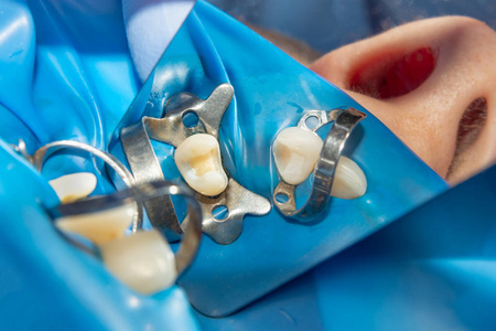 玻璃纤维引脚牙髓治疗后牙齿的修复。 美学骨科牙科的概念