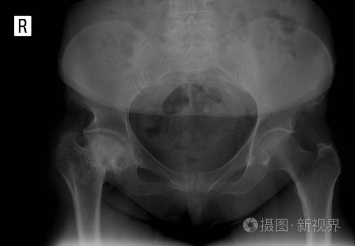 骨盆的x线. 右髋关节畸形关节. 股骨头无菌坏死.