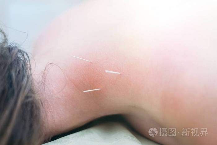 理疗师为一名年轻女子背部针灸
