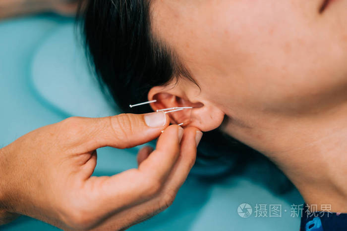 理疗师在她耳朵上给一个年轻女人做针灸