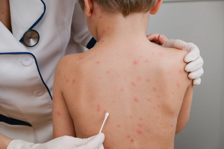 医生在婴儿皮肤上涂上水痘引起的水泡和皮疹