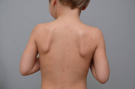 由水痘引起的背部和颈部充满水泡疤痕和皮疹的特写镜头