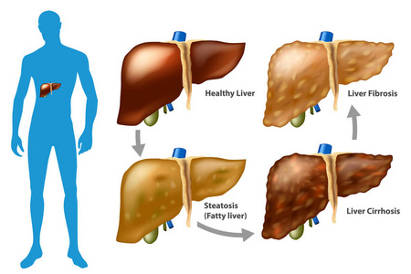 肝损害的分期..肝病的进展.脂肪纤维化肝硬化