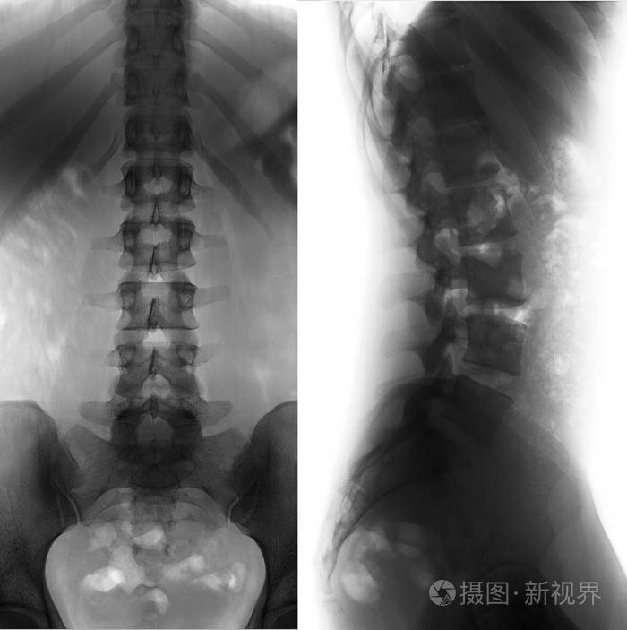 腰骶椎x线正常的否定完美