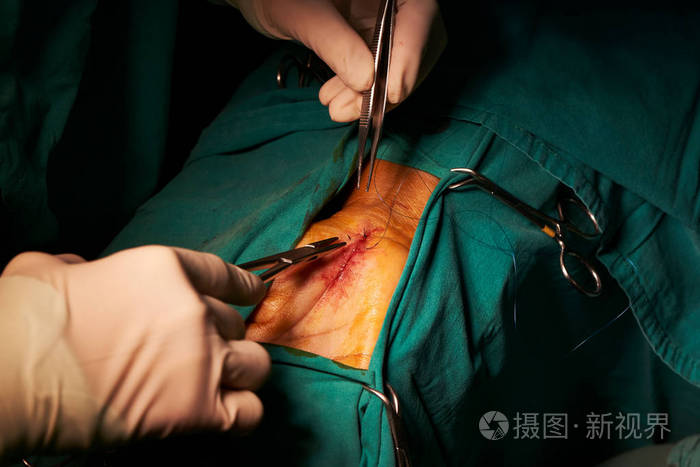 医生拿着针架在手术室缝针