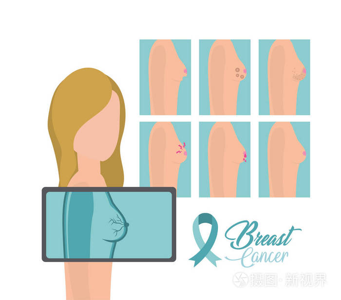 女性乳腺癌预防诊断向量说明