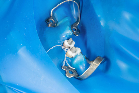 人颌骨石膏模型牙冠。 宏观关闭制造牙齿解剖冠的过程。 牙齿修复的概念
