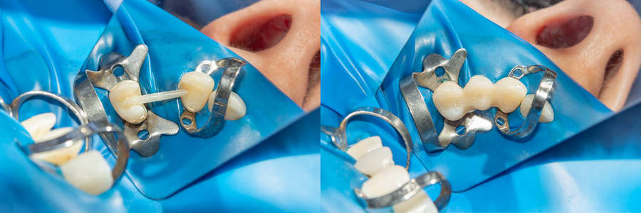 用粘合复合材料填充和修复牙齿脱落。 牙科治疗前后的概念