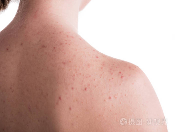 痤疮问题的概念背部皮肤有问题的少女在白色背景上摆姿势