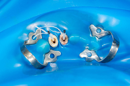 人颌骨石膏模型牙冠。大型特写的过程，制造解剖牙冠。牙齿修复的概念