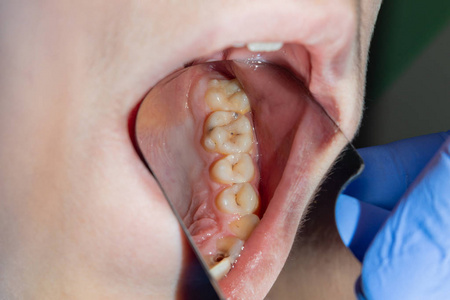 牙科诊所的牙科治疗。 腐烂的龋齿关闭宏观。 根管治疗