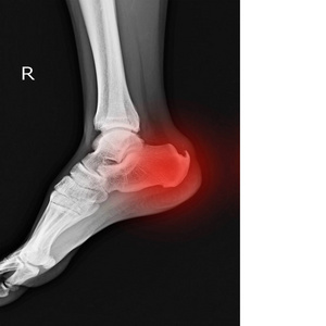 X射线右脚显示跟骨刺的红色与复制空间。