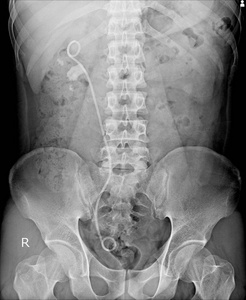 腹部X线显示双j支架，以减轻肠绞痛从肾结石。太软时，看到充分的Solusion。医学图像。