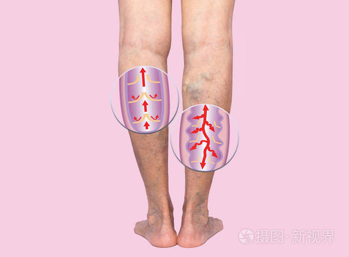 女性的高级腿上的静脉曲张.正常和静脉曲张的结构