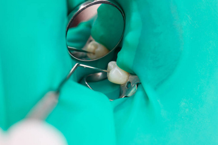 特写乳胶板, 旨在隔离牙齿从治疗过程中的口腔休息。牙医准备了牙齿进行治疗