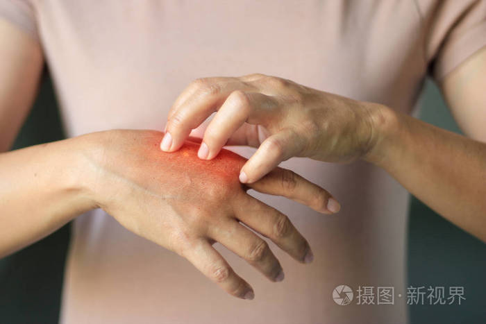 女性抓挠手上的瘙痒,引起皮肤疾病瘙痒,干性皮肤过敏,对洗涤剂或洗碗