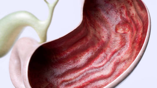 胃溃疡2期3高细节三维渲染