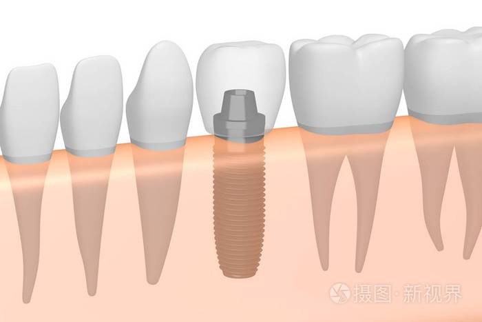 种植牙种植牙