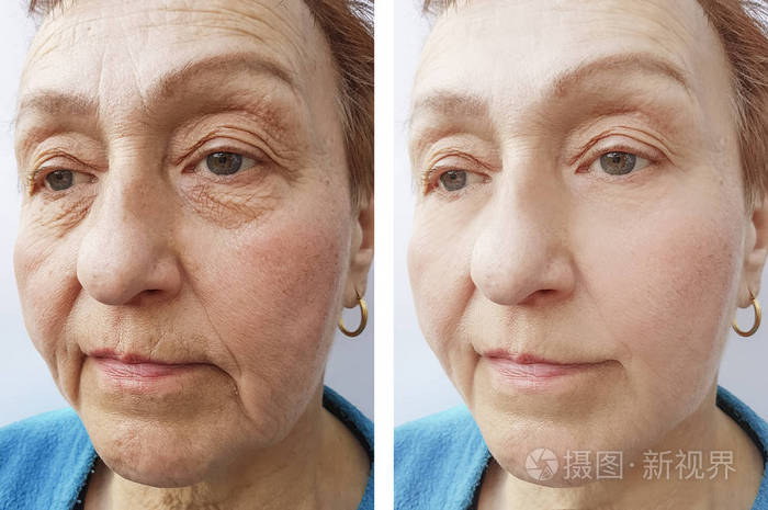 一位老妇人的脸在手术前后出现皱纹
