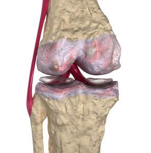骨关节炎 膝关节韧带和软骨