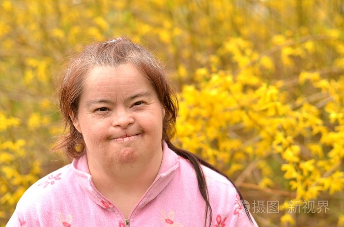 唐氏综合征的女人