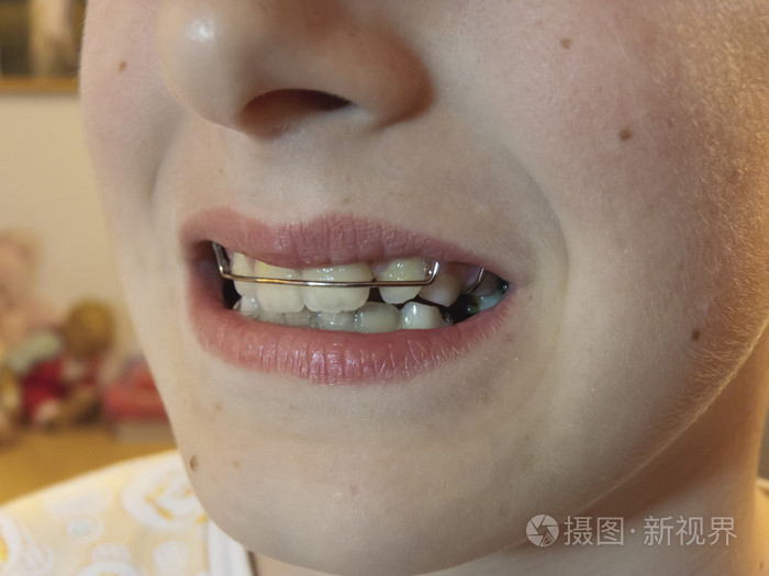 牙齿矫正支架