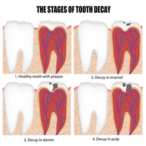牙龋各阶段的关系图图片
