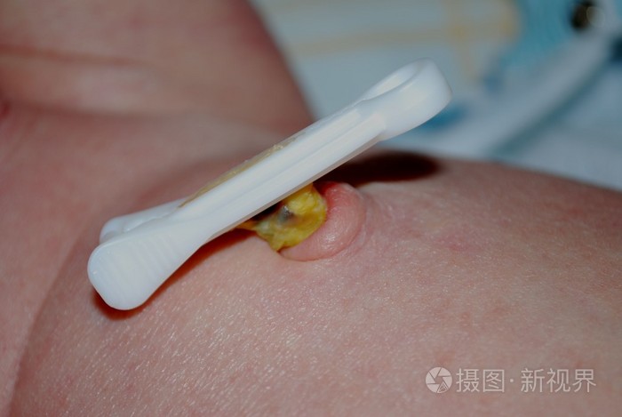 新生儿肚脐脐带剪