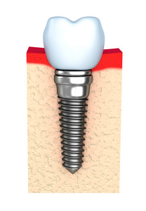 在下颚骨牙种植体