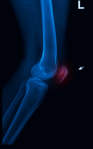 创伤膝关节 x 射线图像垂直