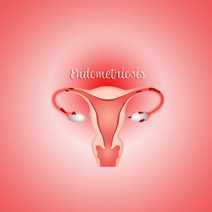 子宫内膜异位症患者 endometrioum