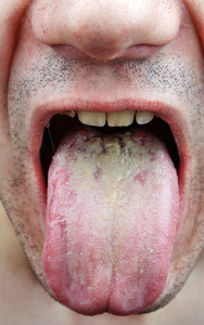 疾病的舌头图片