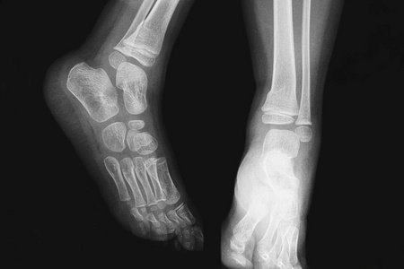 X 射线儿童的断腿的快照