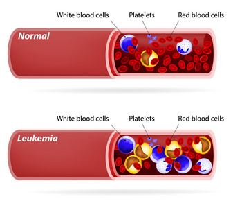 癌症。白血病或白血病