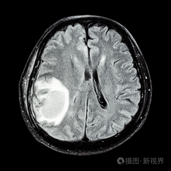 磁共振脑: 显示大脑右顶叶脑肿瘤