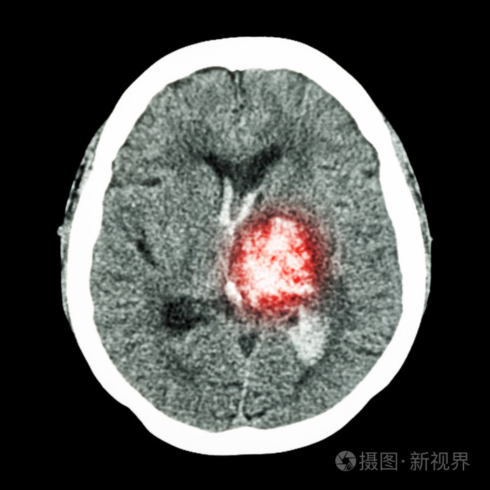 ct脑:左侧丘脑出血(出血性卒中)照片-正版商用图片1hsyn5-摄图新视界