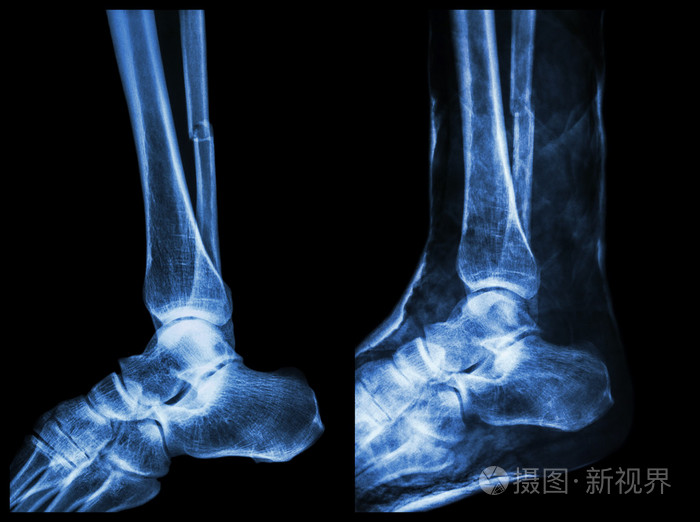 左图: 骨折腓骨 (小腿骨头) 轴, 右图像: 它用石膏夹板固定情况下