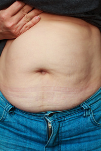 极度肥胖女人的肚子图片