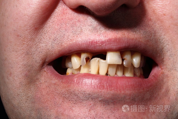 坏牙吸烟者