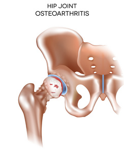 关节炎的髋关节