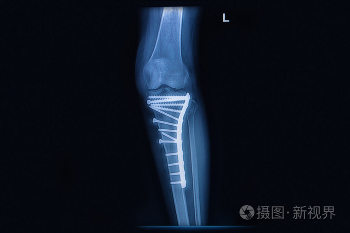 x 射线的骨折 tibia(leg bone).胫骨骨与内部定势