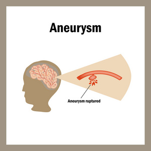 打破 anevrizmy。Krovoizliyanie 脑。中风 动脉粥样硬化 动脉瘤。胆固醇斑块。信息图表。矢量图