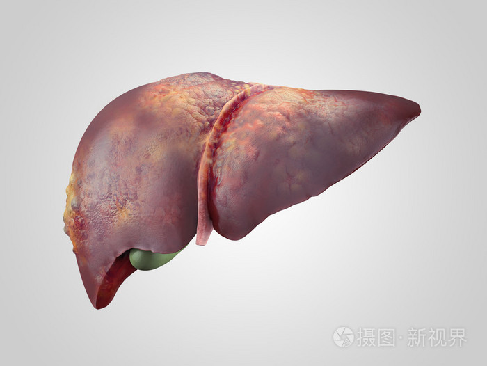 与癌症病人体肝脏