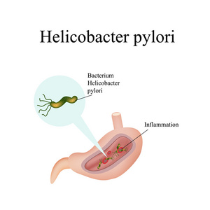 幽门螺杆菌在胃里。信息图表。矢量图