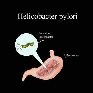 幽门螺杆菌在胃里。信息图表。矢量图