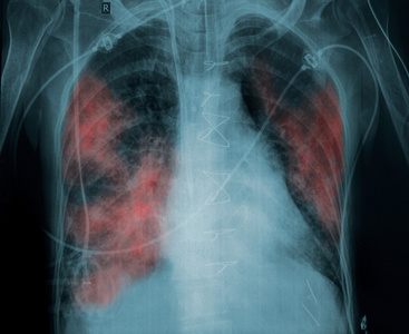 张 x 光片的患者肺病理变化