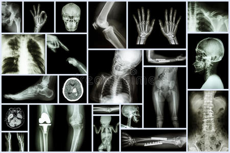 收集X线多部位的人类和骨科手术和多发性疾病骨关节炎，膝下肌松，中风骨折
